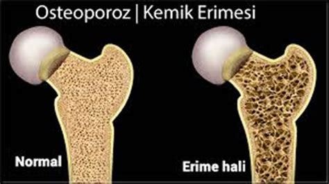 osteoporoz hangi branş